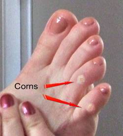 Corns