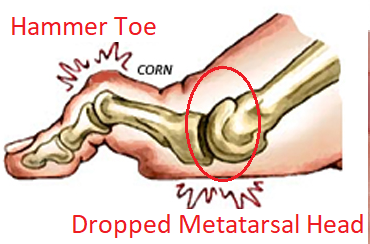 Dropped metatarsal heads