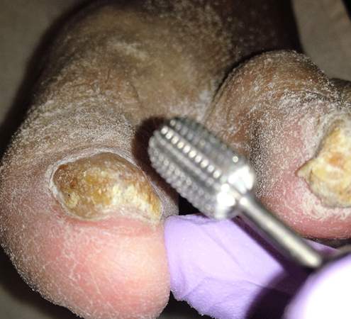 Debridement